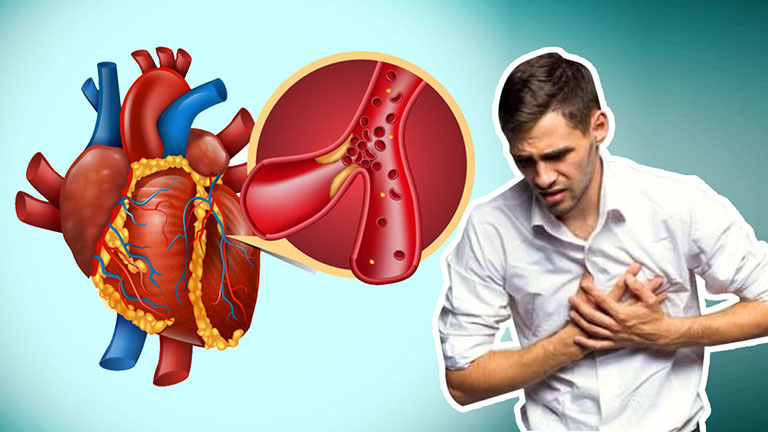 Nhồi máu cơ tim và ngừng tim ở nam giới: Dấu hiệu cảnh báo không nên chủ quan