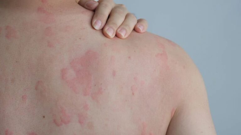 Dị ứng có hết hoàn toàn không? Chuyên gia giải đáp cách kiểm soát dị ứng hiệu quả