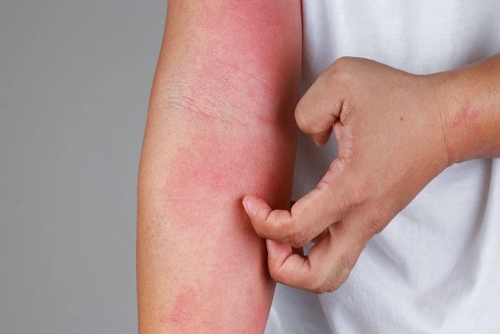 Xét nghiệm dị ứng thực phẩm: Khi nào cần làm và các phương pháp hoạt động như thế nào