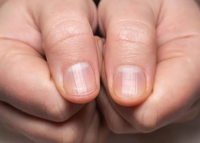 Móng tay có sọc dọc trắng