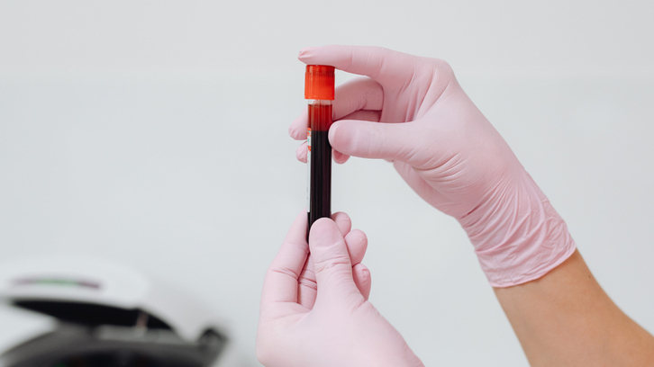 Phân tích hơn 1.200 người để xác định 34 RNA vòng liên quan Alzheimer
