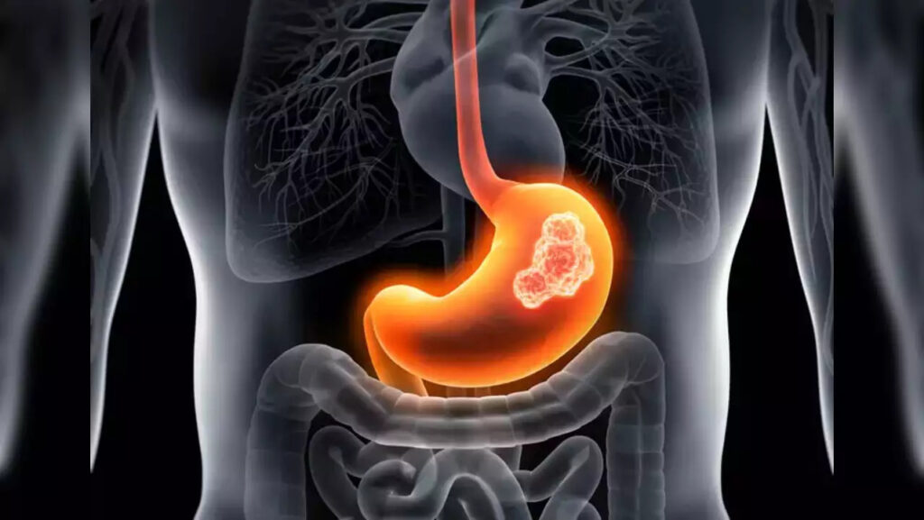 Đau dạ dày là cách gọi phổ biến của tình trạng đau hoặc khó chịu ở vùng bụng trên