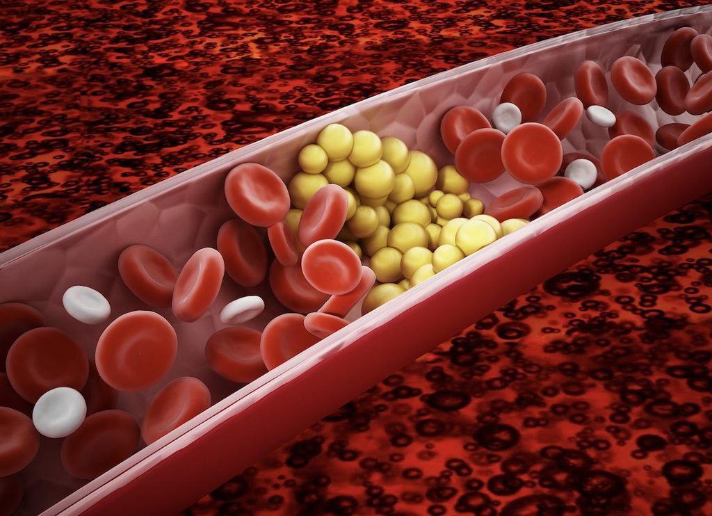 Mỡ máu cao, hay rối loạn lipid máu, là tình trạng một hoặc nhiều chỉ số lipid trong máu nằm ngoài phạm vi phù hợp