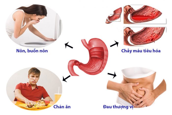 Những triệu chứng đau dạ dày thường gặp